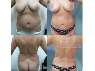 Pexia con implantes
