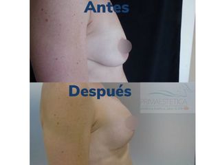 Pexia con implantes