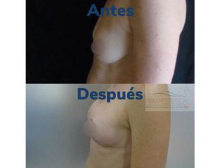 Pexia con implantes