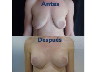 Pexia con implantes