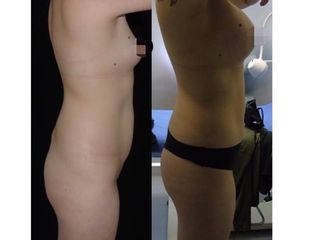 aumento mamario con una mini lipo