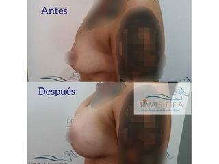 Aumento mamario - Clínica Primaestetica