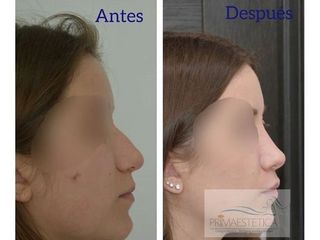 Rinoplastia - Clínica Primaestetica