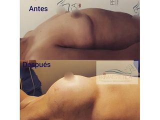Aumento mamario - Clínica Primaestetica