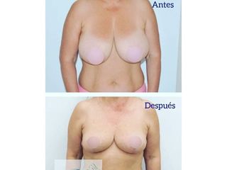 Reducción mamaria - Clínica Primaestetica