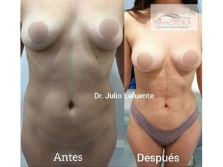 Liposucción - Clínica Primaestetica