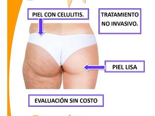 Celulitis