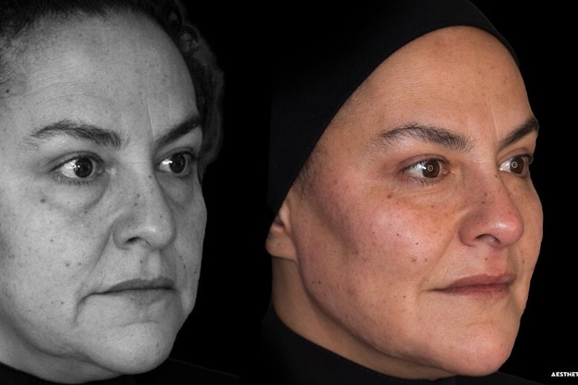 Lifting antes y después - 822371