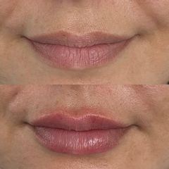 Aumento de labios - Dra. Evelyn Schneider M.