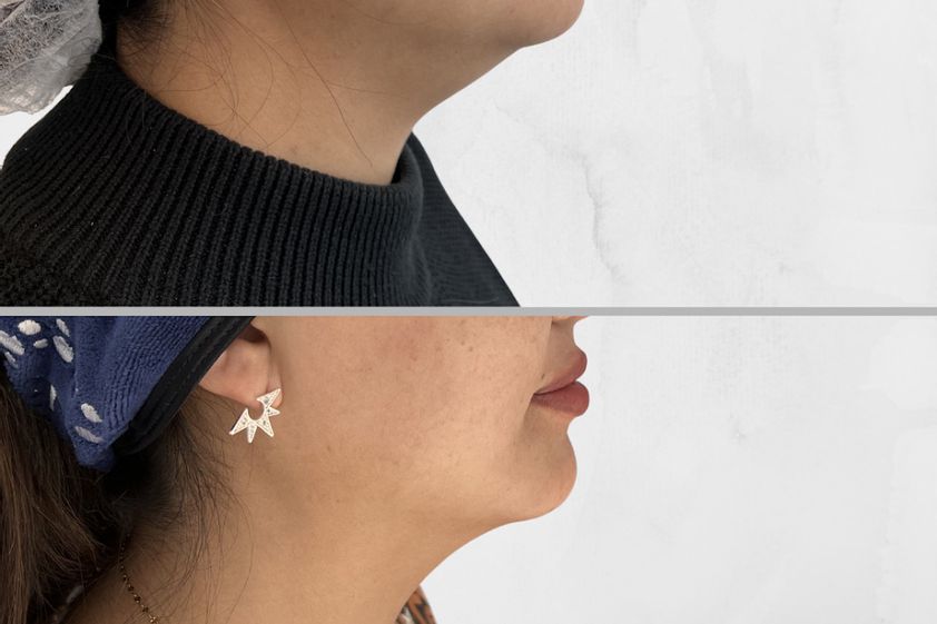 Mesoterapia antes y después - 829260