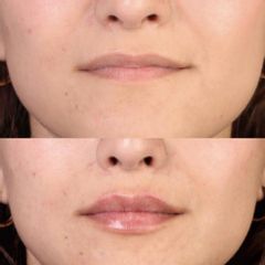 Aumento de labios - Dra. Evelyn Schneider M.