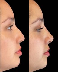 Rinomodelación - Dra. Evelyn Schneider M.