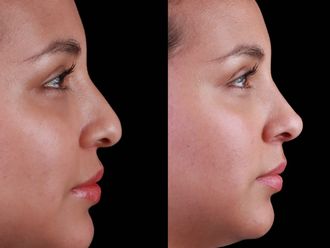 Rinomodelación antes y después - 877375