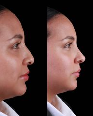 Rinomodelación - Dra. Evelyn Schneider M.