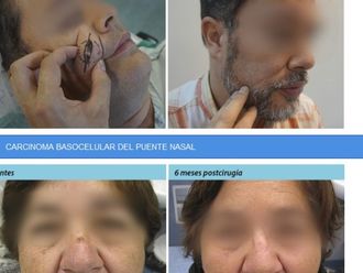 Borrar cicatrices antes y después - 575133