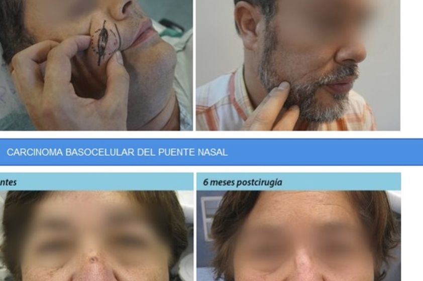 Borrar cicatrices antes y después - 575133