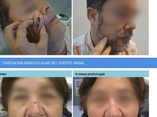 Casos dermocirugia