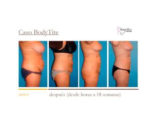 Caso Bodytite