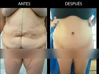 Abdominoplastía