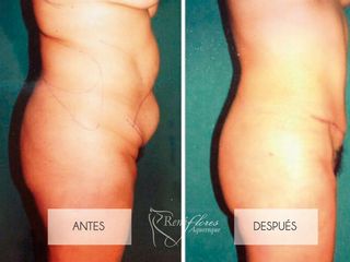 Liposucción