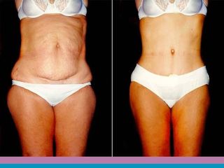 Abdominoplastía de Pitanguy