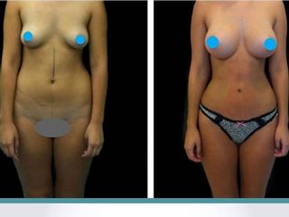Aumento mamario con Lipoescultura