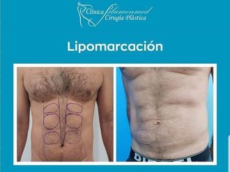 Lipoescultura Antes y después - Clinicasesteticas.cl