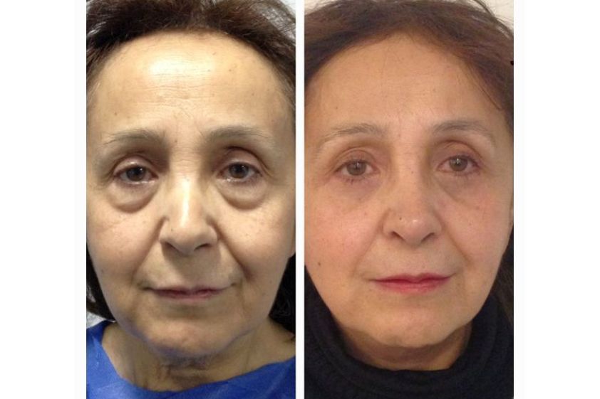 Tratamiento de bolsas en los ojos antes y después - 636578