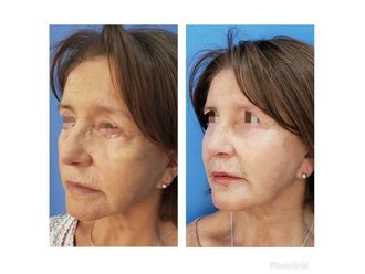 Rejuvenecimiento facial - 636585