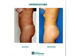 Lipoescultura