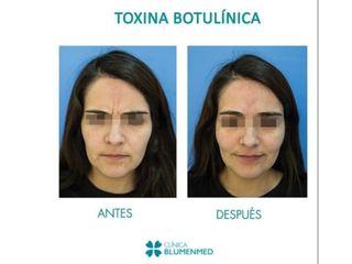 Toxina Botulinica