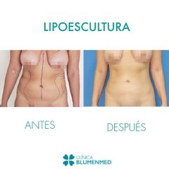Lipoescultura - Clínica Doctor Flores Aqueveque