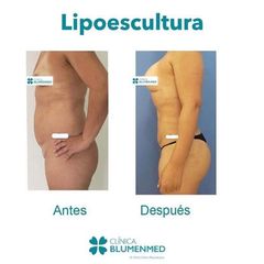 Lipoescultura - Clínica Doctor Flores Aqueveque