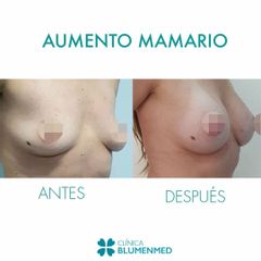 Aumento mamario - Clínica Doctor Flores Aqueveque