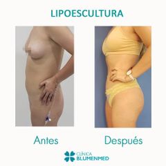 Lipoescultura - Clínica Doctor Flores Aqueveque