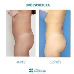Lipoescultura - Clínica Doctor Flores Aqueveque