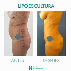 Lipoescultura - Clínica Doctor Flores Aqueveque