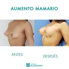 Aumento mamario - Clínica Doctor Flores Aqueveque