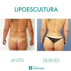 Lipoescultura - Clínica Doctor Flores Aqueveque
