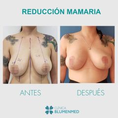 Reducción mamaria - Clínica Doctor Flores Aqueveque