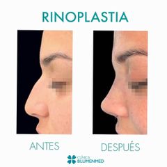 Rinoplastia - Clínica Doctor Flores Aqueveque