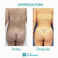 Lipoescultura - Clínica Doctor Flores Aqueveque