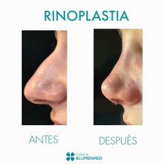Rinoplastia - Clínica Doctor Flores Aqueveque