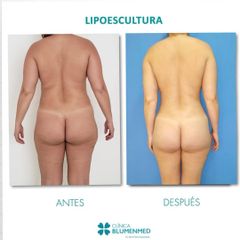 Lipoescultura - Clínica Doctor Flores Aqueveque
