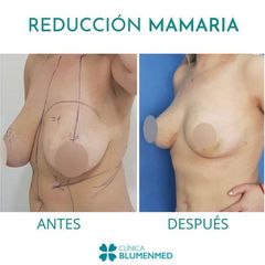 Reducción mamaria - Dr. René Flores Aqueveque