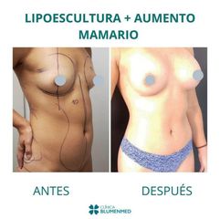 Lipoescultura - Dr. René Flores Aqueveque