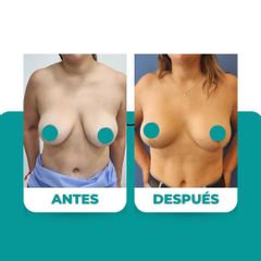 Mastopexia - Dr. René Flores Aqueveque