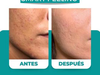 Peeling antes y después - 861665