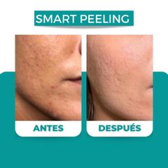 Peeling - Dr. René Flores Aqueveque