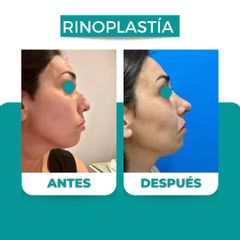 Rinoplastia - Dr. René Flores Aqueveque